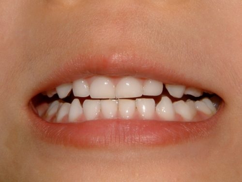 歯並び2